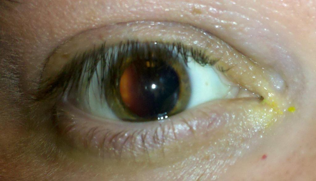 Народное лечение глаукомы: отзывы