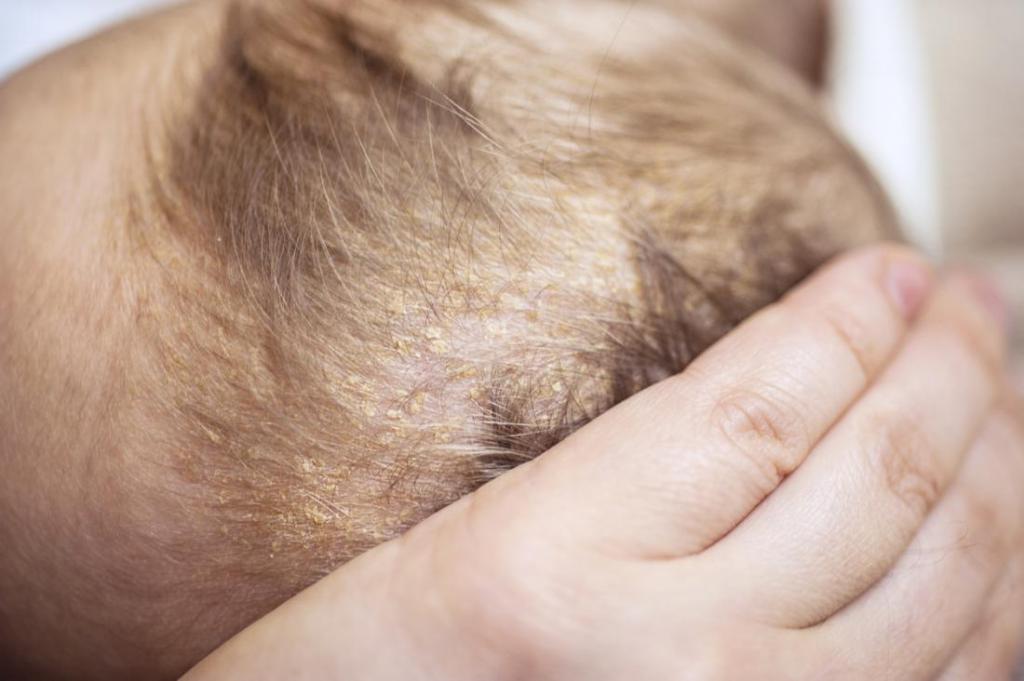 лечение себореи кожи головы народными средствами отзывы кто вылечился