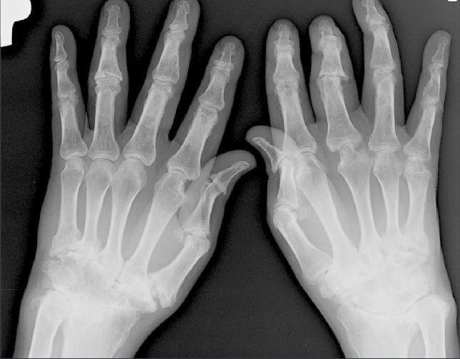 Artritis psoriasica manos
