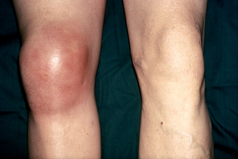 воспаление колена при артрите