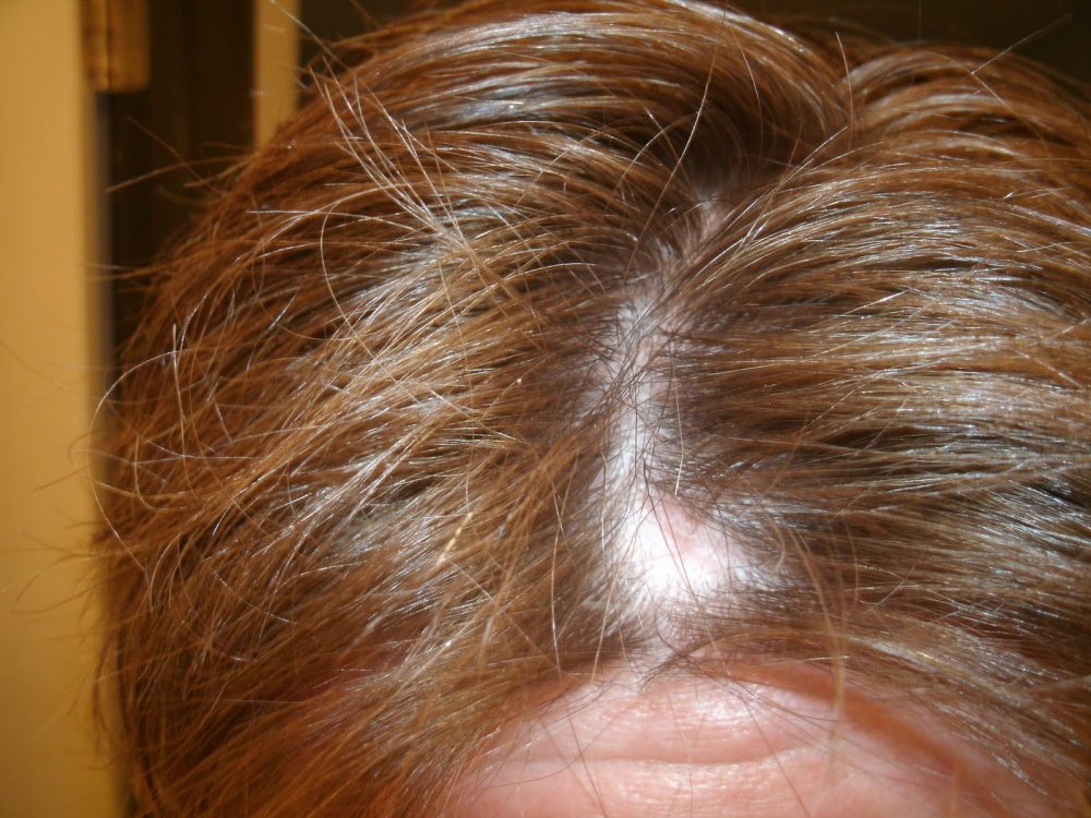 локализованное выпадение волос