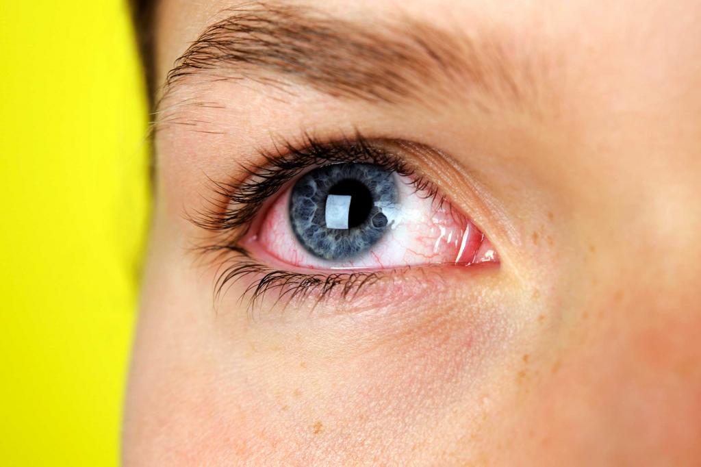 Симптомы синдрома сухого глаза