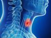 Как вылечить рак щитовидной железы народными