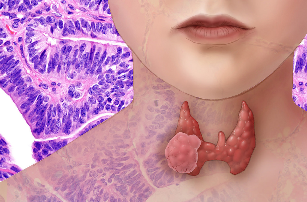 Как вылечить рак щитовидной железы народными thumbnail